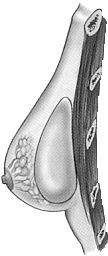 Medische illustratie borstvergroting prothese onder klierweefsel