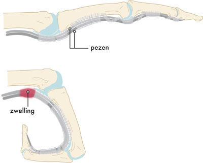 Medische illustratie hokkende vinger