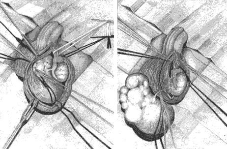 Illustratie operatie hydrocele of spermatocele 2