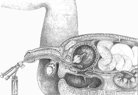 Illustratie percutane niersteenverwijdering man