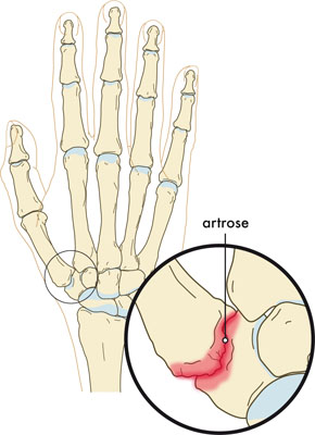 Medische illustratie artrose hand