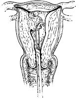 Illustratie endometriumresectie