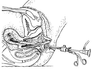 Illustratie hysteroscopie