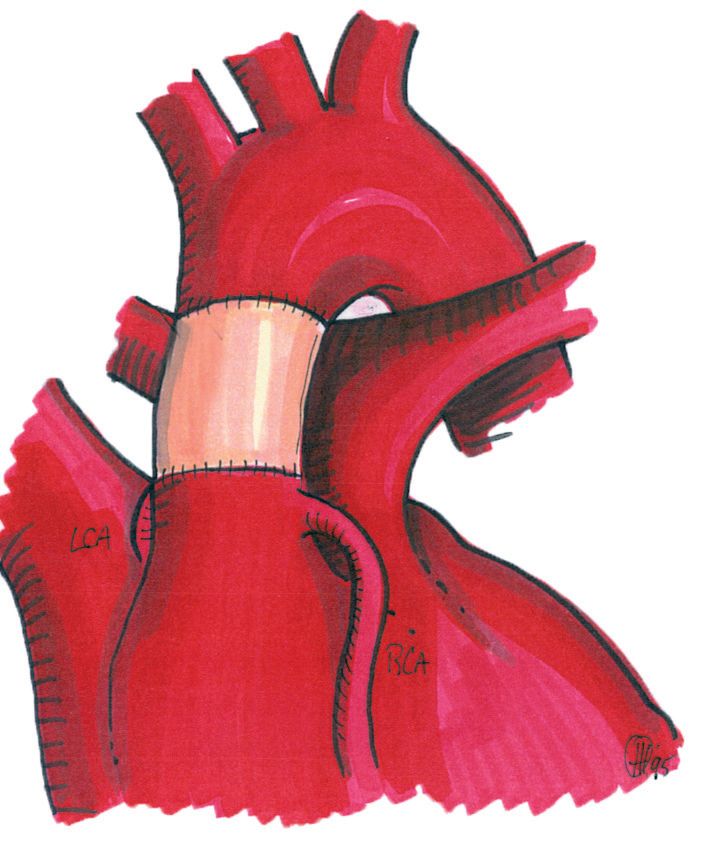 Afbeelding vervanging aorta ascendens