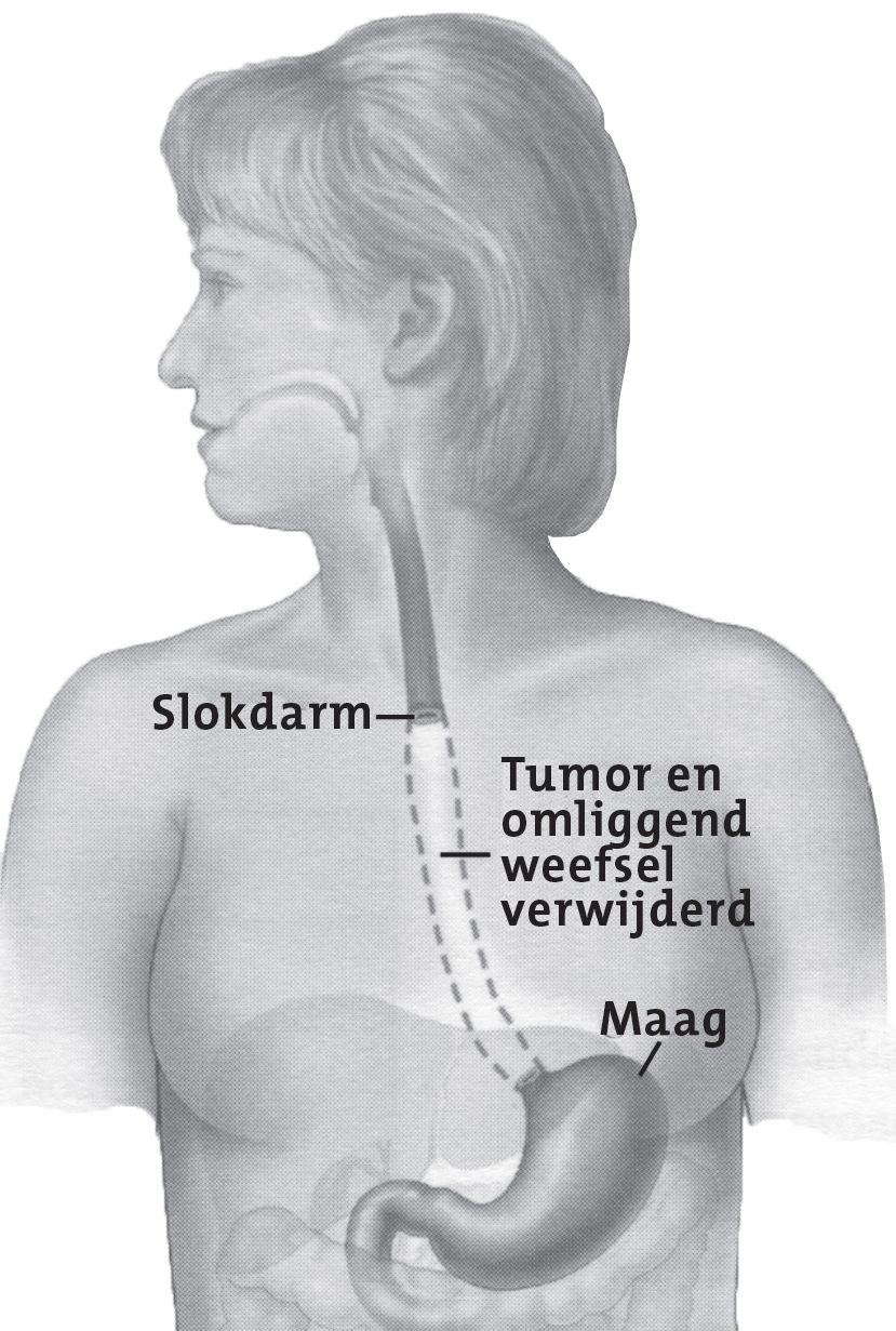 Afbeelding tumor en weefsel verwijderd
