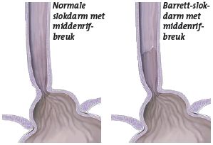 Afbeelding middenrifbreuk slokdarm