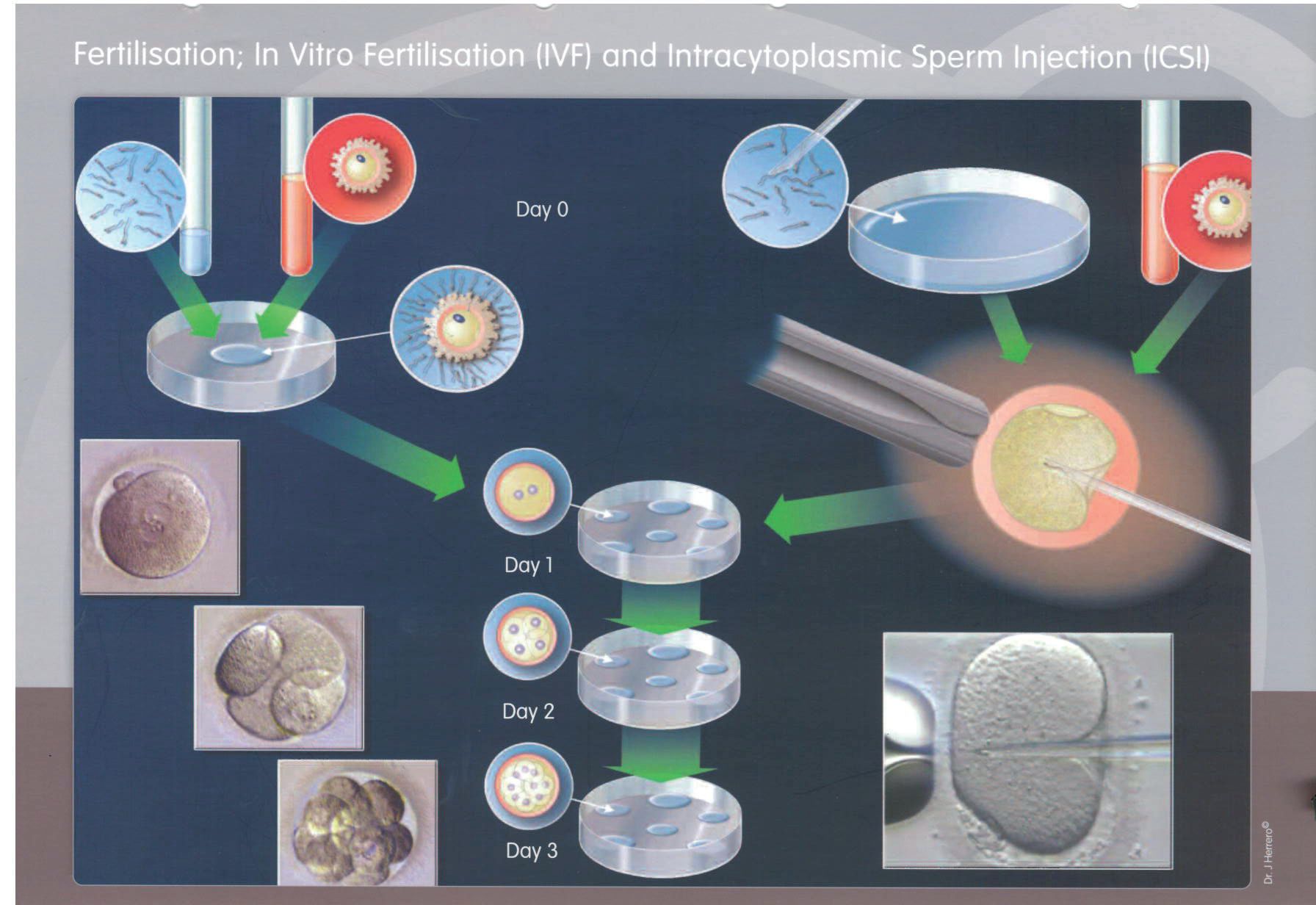 Medische illustratie IVF- en ICSI-behandeling