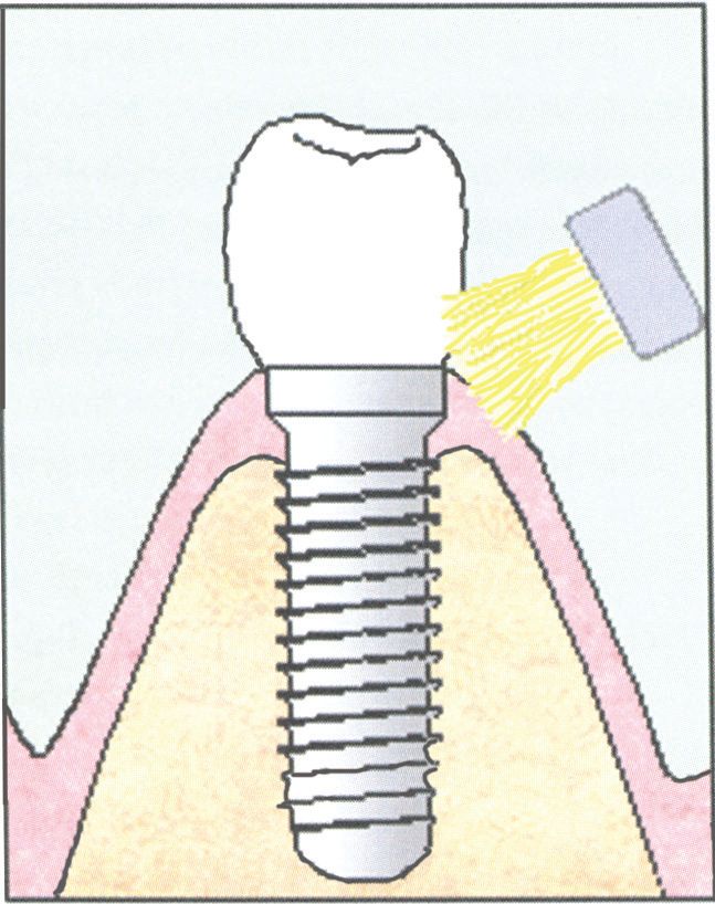 Medische illustratie tanden poetsen
