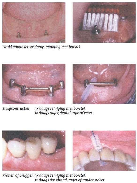 Voorbeelden van het poetsen van implantaten