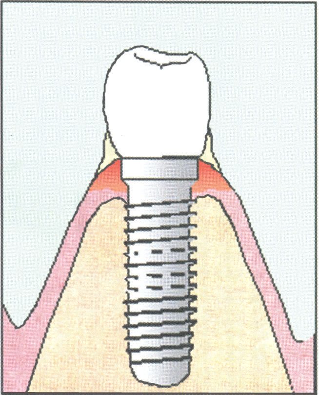 Medische illustratie tandvleesontsteking door tandplak