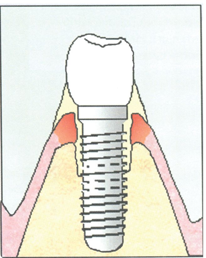Medische illustratie botverlies door tandplak