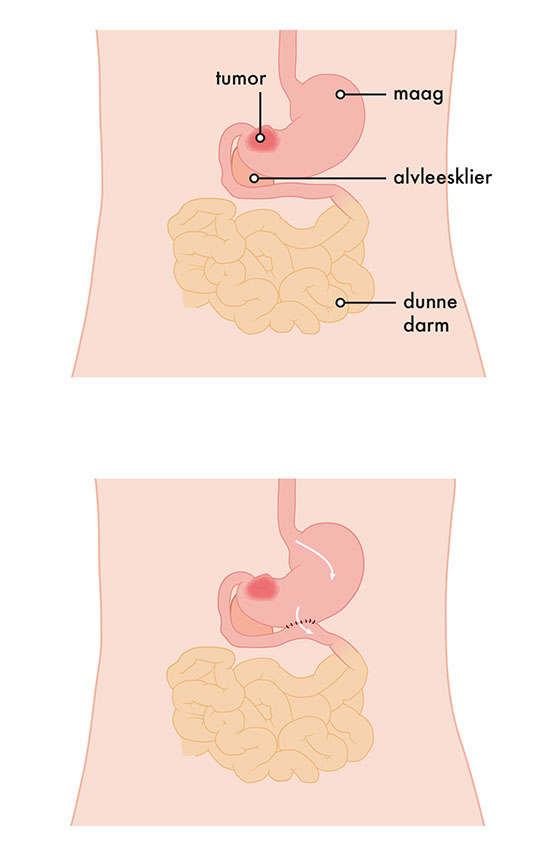 Medische illustratie gastro-enterostomie