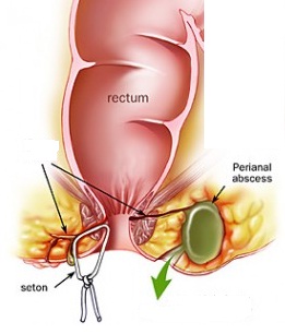 Medische illustratie seton bij een fistel aan de anus