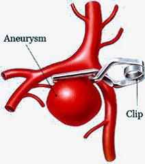Illustratie clippen aneurysma