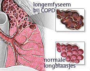 Afbeelding COPD