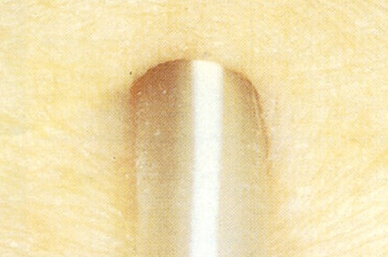 Afbeelding huidpoort katheter