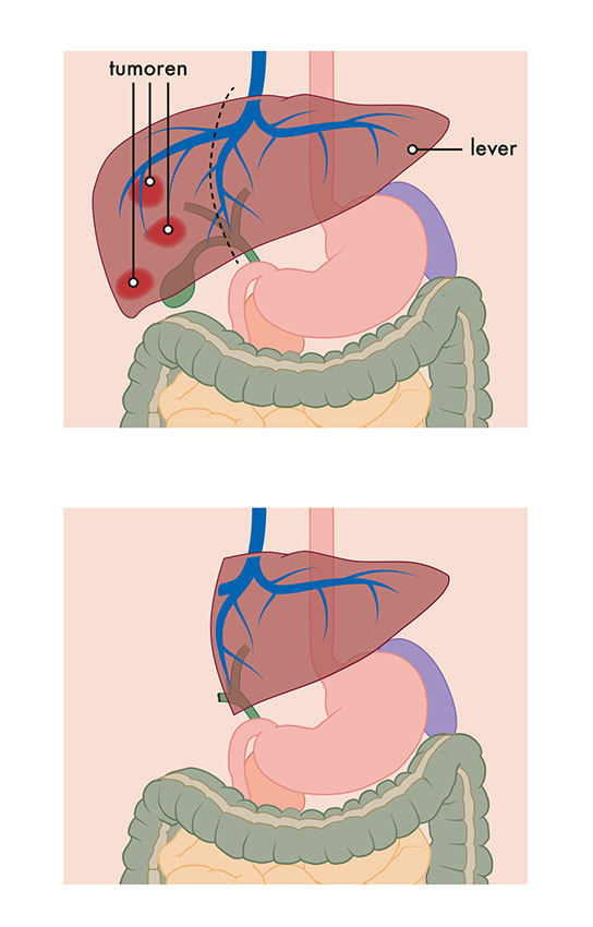 Afbeelding Hemihepatectomie rechts