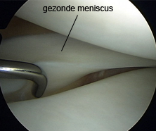 Afbeelding gezonde meniscus
