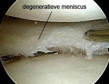 Afbeelding degeneratieve meniscus