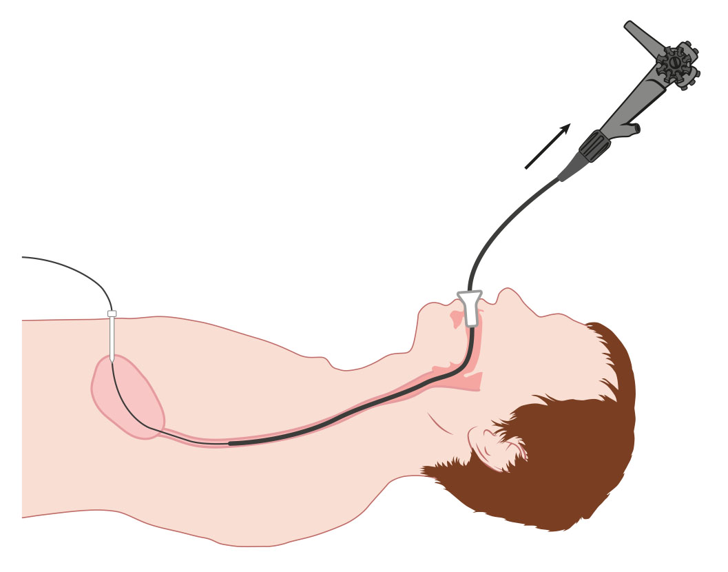 Medische illustratie plaatsen PEG-sonde 2