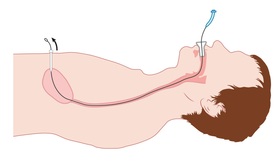 Medische illustratie plaatsen PEG-sonde 3