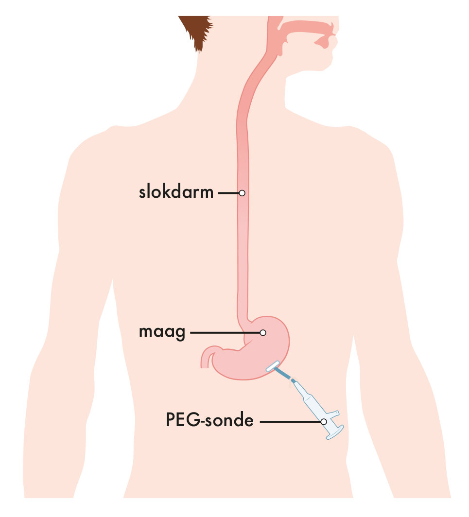 Medische illustratie PEG-sonde