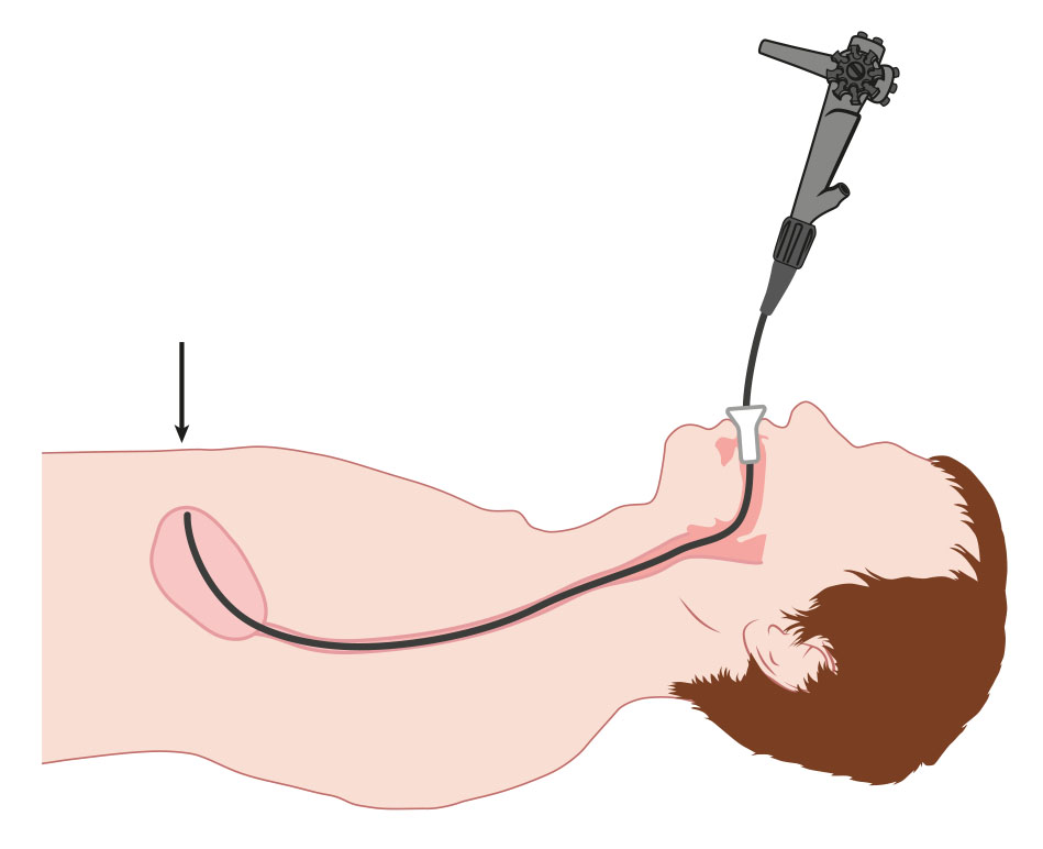 Medische illustratie plaatsen PEG-sonde