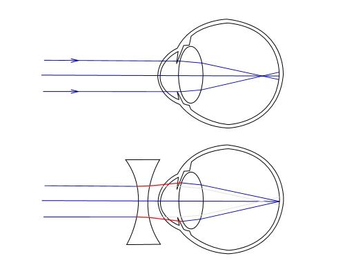 Afbeelding myoop oog met en zonmder correctie