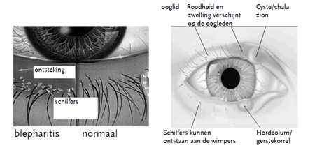 Illustratie oogontsteking