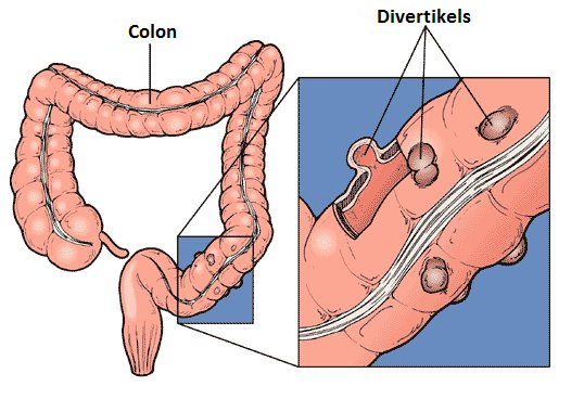 Tratamiento para la diverticulitis del colon