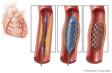 Afbeelding 3: coronair stent