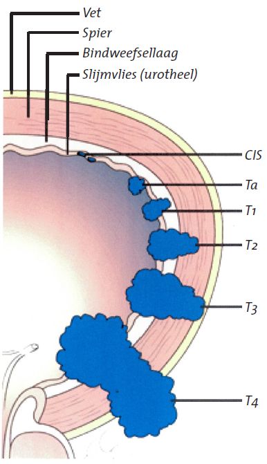 Medische illustratie stadia van blaaskanker