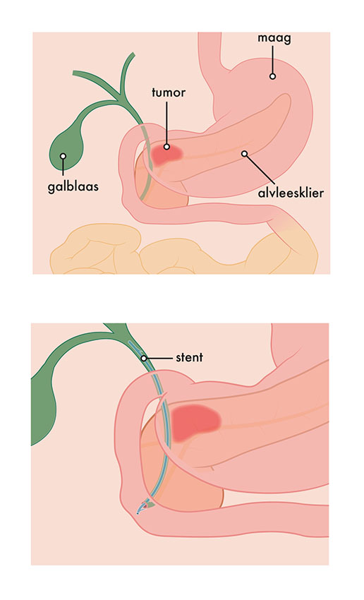 Medische illustratie stent bij alvleesklierkanker