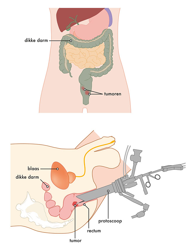 Medische illustratie TAMIS-TEM operatie