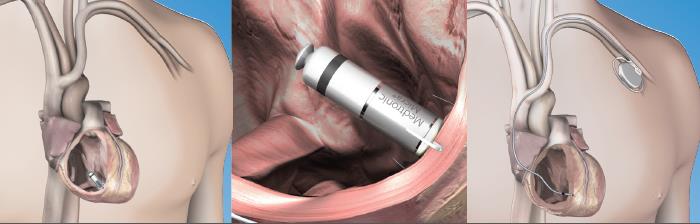 Medische illustratie draadloze pacemaker