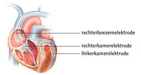 Medische illustratie hart met pacemaker