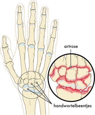 Medische illustratie artrose