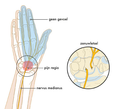 Medische illustratie zenuwletsel in hand