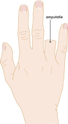 Medische illustratie amputatie vinger
