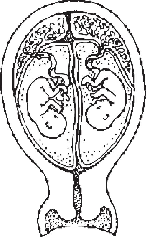 Afbeelding samengegroeide placenta