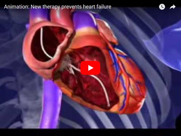 Screenshot animatie plaatsen elektrode in het hart