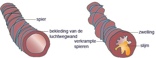 Afbeelding normale luchtweg en astma