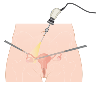Medische illustratie laparoscopie
