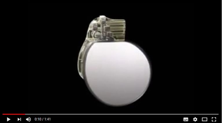 SCreenshot video plaatsen elektroden bij pacemaker