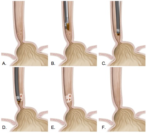 Illustratie RFA behandeling met een apparaatje op de endoscoop