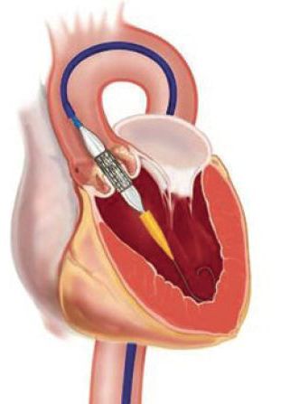 Illustratie aortaklepprothese in het hart