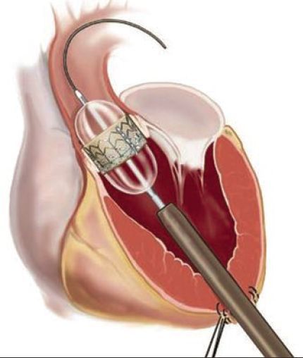 Illustratie implantatie aortaklepprothese via punt hart