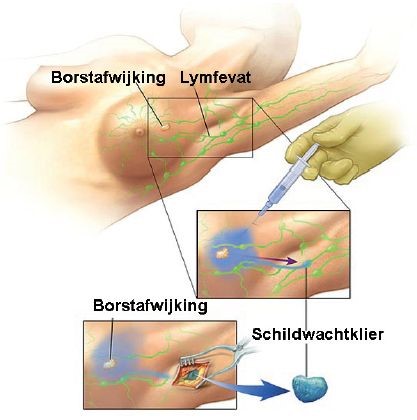 Illustratie schildwachtklierprocedure