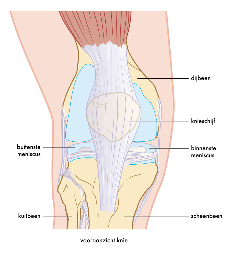 Illustratie gescheurde meniscus vooraanzicht knie