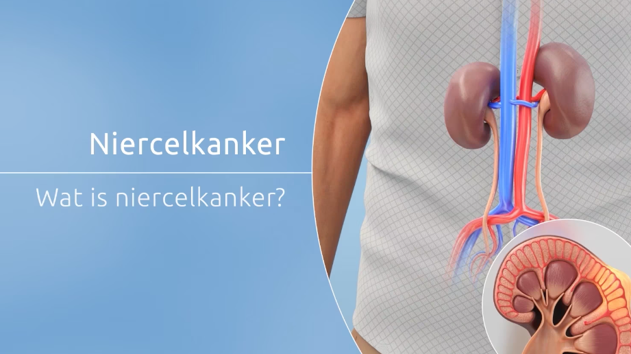 Screenshot niercelkanker informatievideo